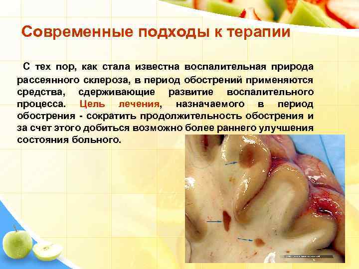 Современные подходы к терапии С тех пор, как стала известна воспалительная природа рассеянного склероза,