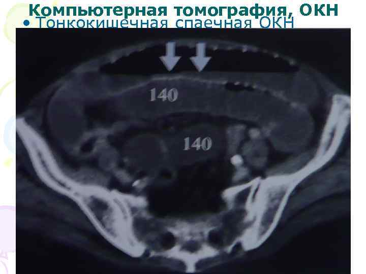 Компьютерная томография, ОКН • Тонкокишечная спаечная ОКН 