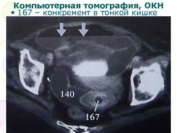 Компьютерная томография, ОКН • 167 – конкремент в тонкой кишке 