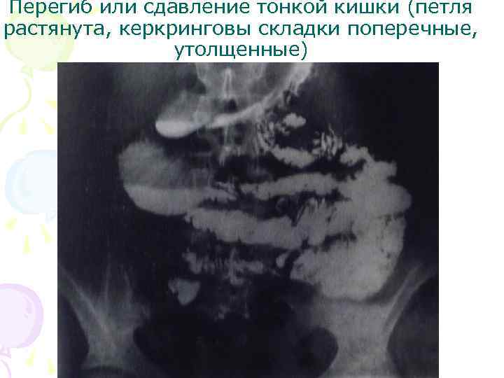 Перегиб или сдавление тонкой кишки (петля растянута, керкринговы складки поперечные, утолщенные) 