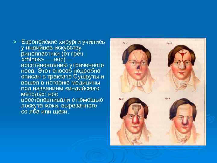 Ø Европейские хирурги учились у индийцев искусству ринопластики (от греч. «rhinos» — нос) —