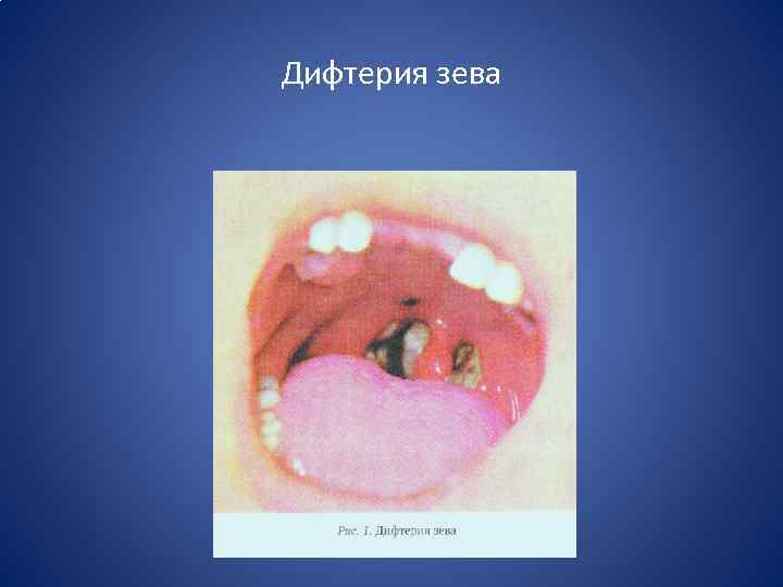 Дифтерия зева 