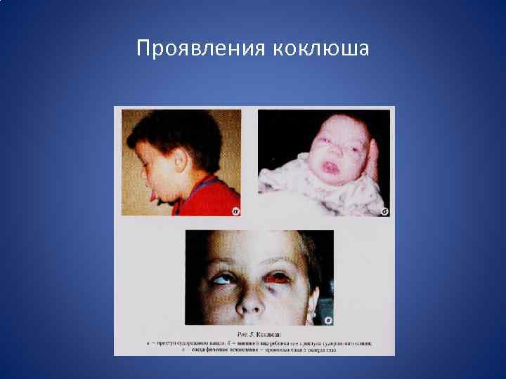 Проявления коклюша 