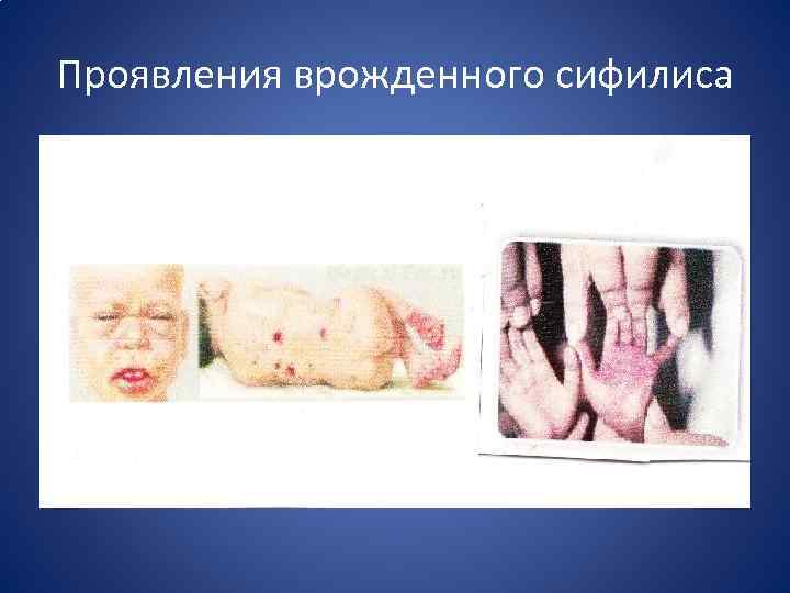 Проявления врожденного сифилиса 