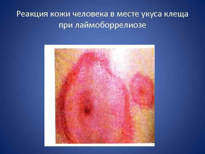 Реакция кожи человека в месте укуса клеща при лаймоборрелиозе 
