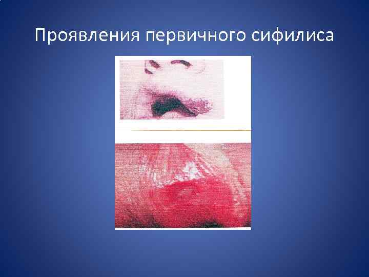 Проявления первичного сифилиса 