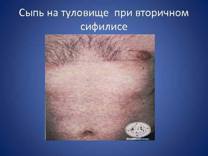 Сыпь на туловище при вторичном сифилисе 