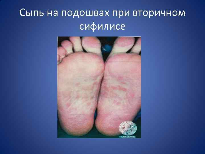 Сыпь на подошвах при вторичном сифилисе 