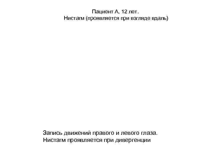 Пациент А, 12 лет. Нистагм (проявляется при взгляде вдаль) Запись движений правого и левого