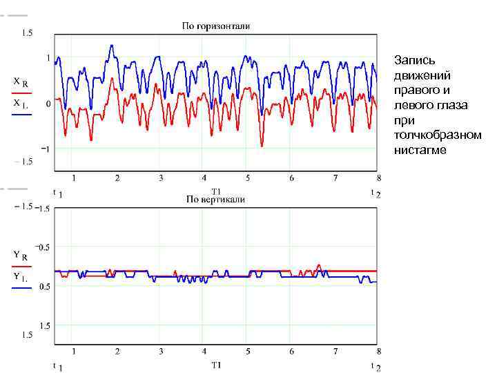 Запись движений правого и левого глаза при толчкобразном нистагме 