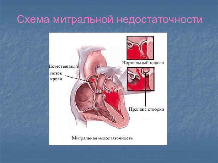 Схема митральной недостаточности 