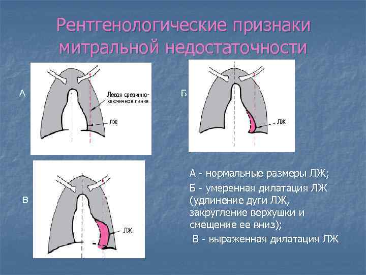 Рентгенологические признаки митральной недостаточности А В Б А - нормальные размеры ЛЖ; Б -