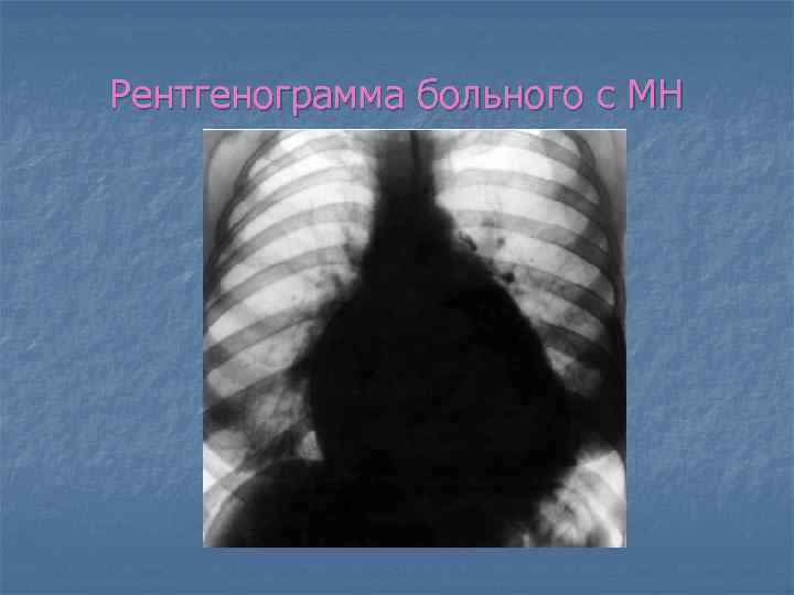 Рентгенограмма больного с МН 