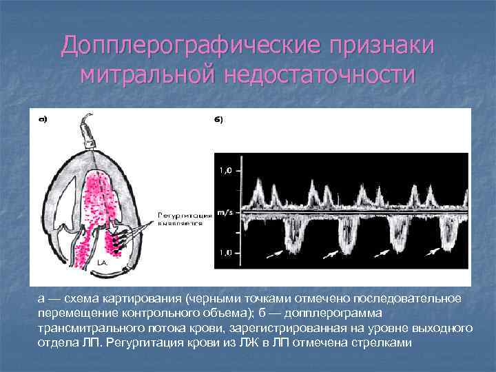 Допплерографические признаки митральной недостаточности а — схема картирования (черными точками отмечено последовательное перемещение контрольного
