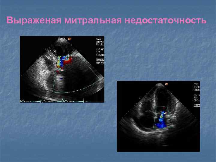 Выраженая митральная недостаточность 