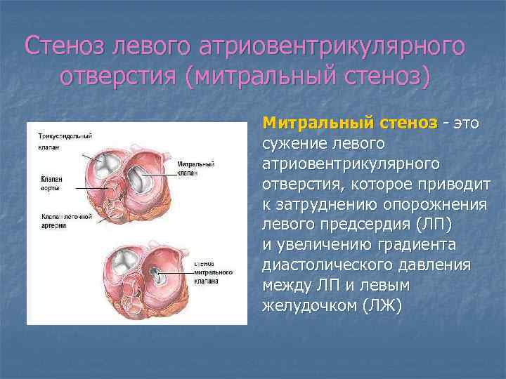 Митральная стеноз презентация