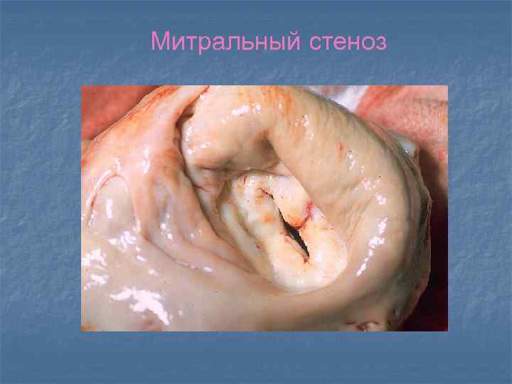 Митральный стеноз 