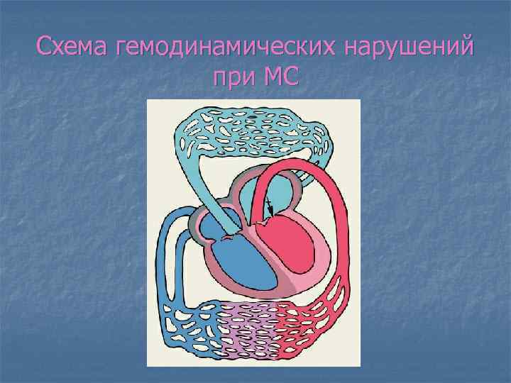 Схема гемодинамических нарушений при МС 