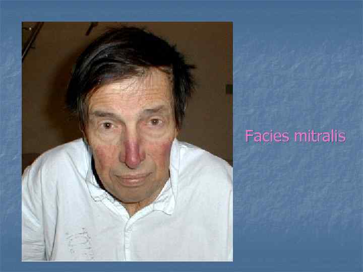 Facies mitralis 