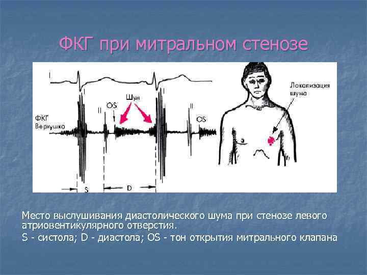 Аускультативная картина при митральном стенозе