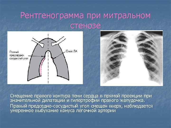 Рентгенограмма при митральном стенозе Смещение правого контура тени сердца в прямой проекции при значительной