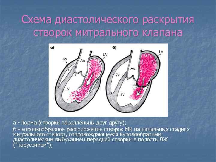 Схема диастолического раскрытия створок митрального клапана а - норма (створки паралленьны другу); б -