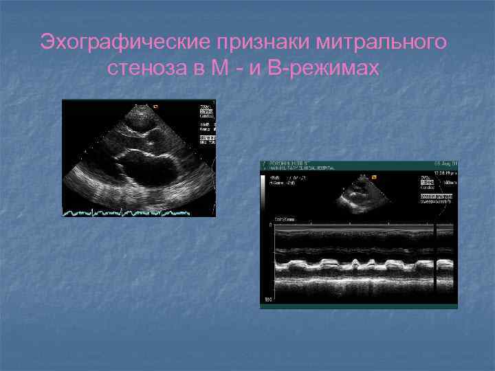 Эхографические признаки митрального стеноза в М - и В-режимах 