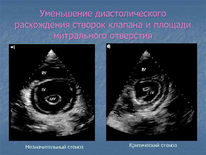 Уменьшение диастолического расхождения створок клапана и площади митрального отверстия Незначительный стеноз Критический стеноз 