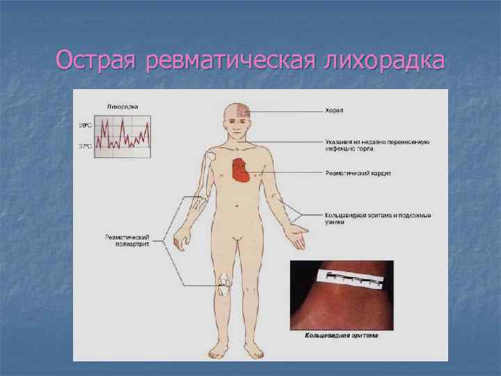 Клиническая картина ревматической лихорадки