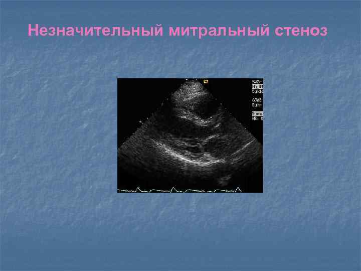 Незначительный митральный стеноз 