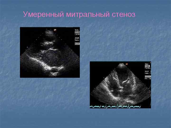 Умеренный митральный стеноз 