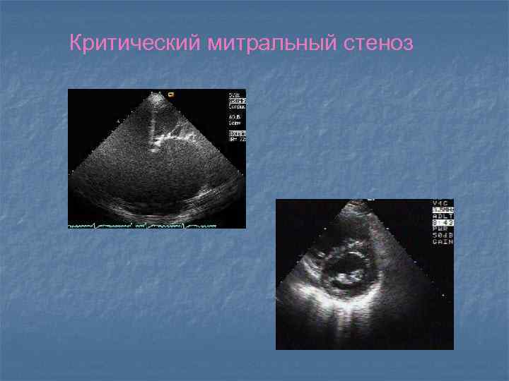 Критический митральный стеноз 