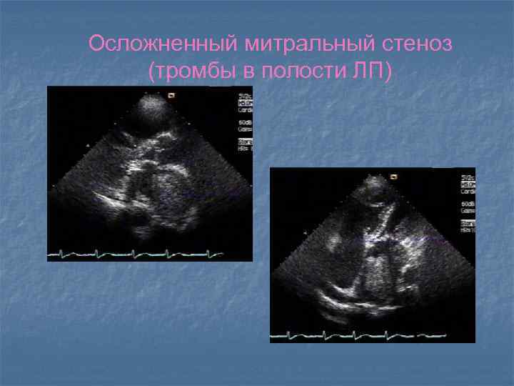 Осложненный митральный стеноз (тромбы в полости ЛП) 