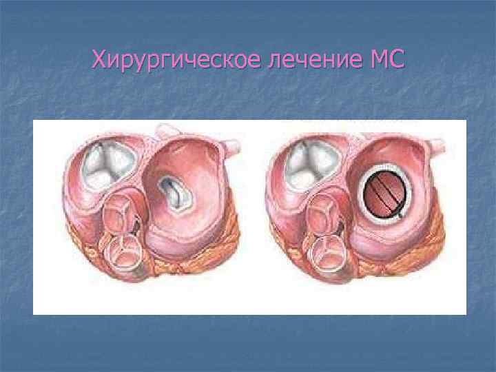 Хирургическое лечение МС 