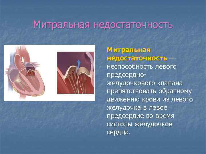 Митральная недостаточность — неспособность левого предсердножелудочкового клапана препятствовать обратному движению крови из левого желудочка