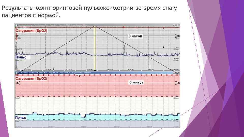 Результаты мониторинговой пульсоксиметрии во время сна у пациентов с нормой. 