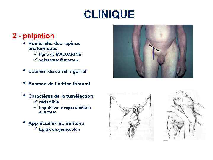 CLINIQUE 2 - palpation • Recherche des repères anatomiques ü ligne de MALGAIGNE ü