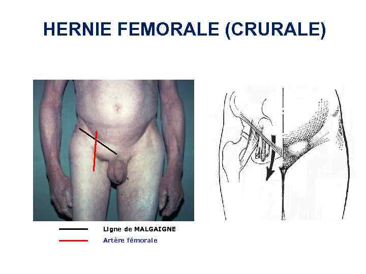 HERNIE FEMORALE (CRURALE) Ligne de MALGAIGNE Artère fémorale 
