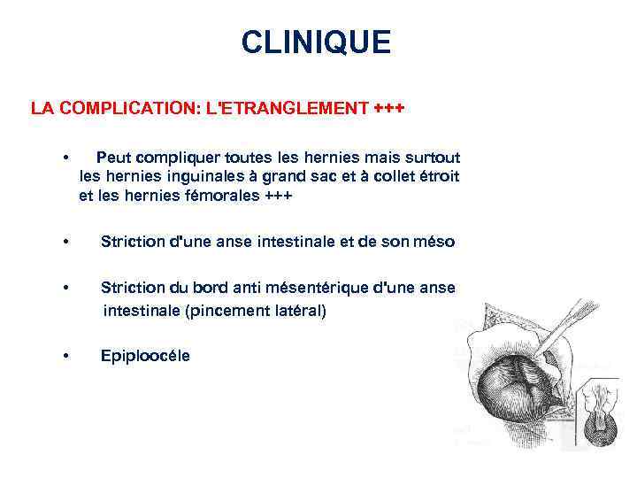 CLINIQUE LA COMPLICATION: L'ETRANGLEMENT +++ • Peut compliquer toutes les hernies mais surtout les