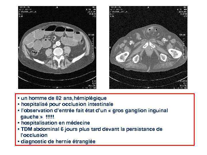  • un homme de 82 ans, hémiplégique • hospitalisé pour occlusion intestinale •