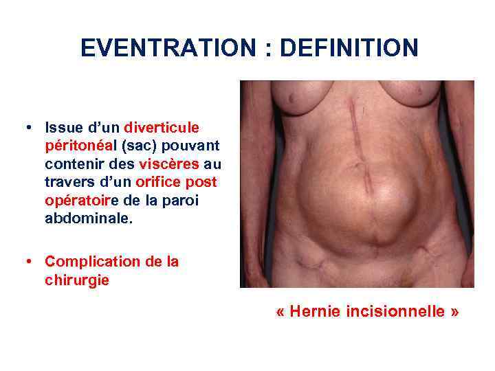 EVENTRATION : DEFINITION • Issue d’un diverticule péritonéal (sac) pouvant contenir des viscères au