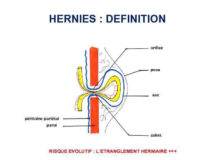 L HERNIES ET EVENTRATIONS HERNIES