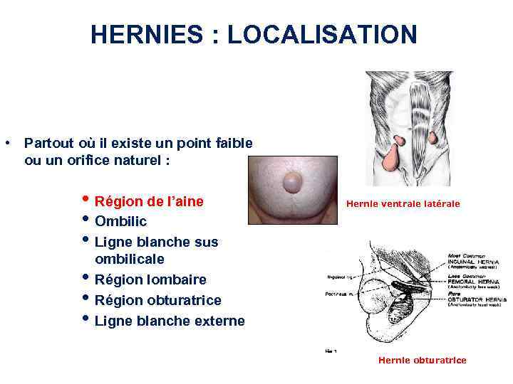 HERNIES : LOCALISATION • Partout où il existe un point faible ou un orifice