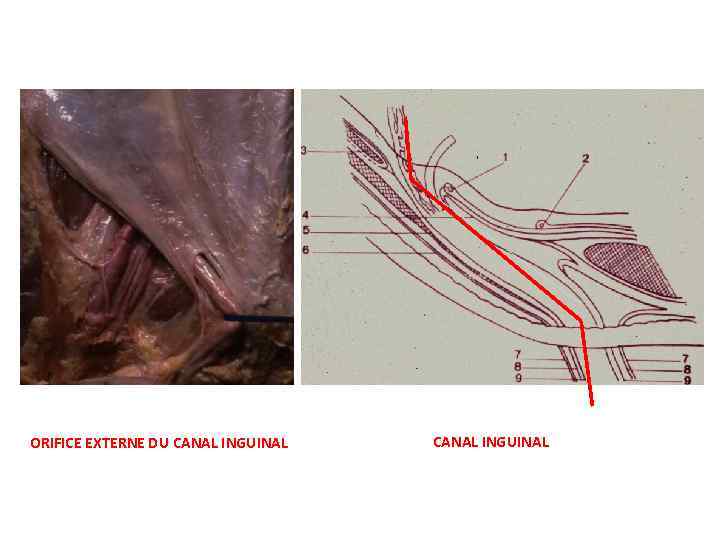 ORIFICE EXTERNE DU CANAL INGUINAL 