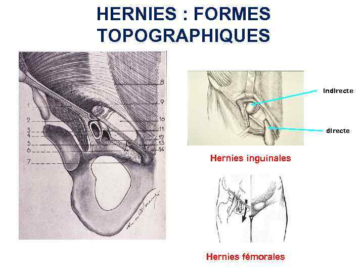 HERNIES : FORMES TOPOGRAPHIQUES indirecte Hernies inguinales Hernies fémorales 