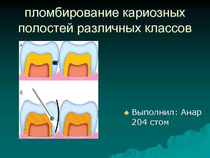 пломбирование кариозных полостей различных классов u Выполнил: Анар 204 стом 