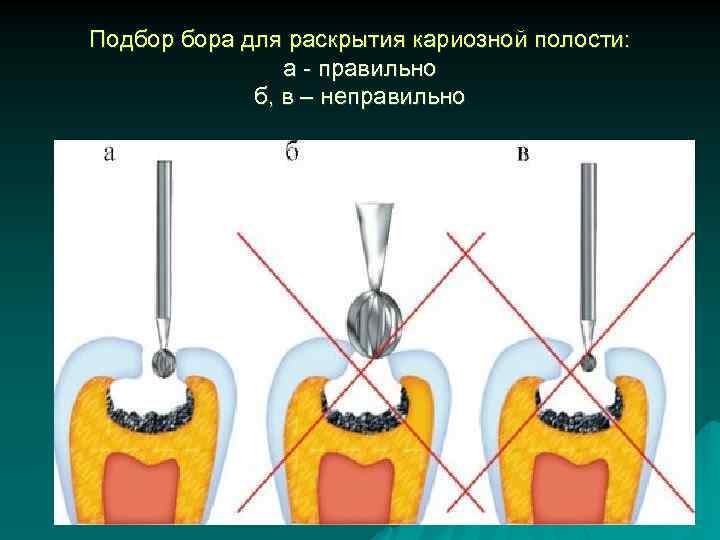 Подбор бора для раскрытия кариозной полости: а - правильно б, в – неправильно 