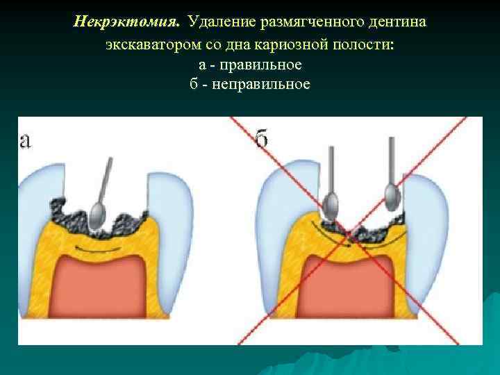  Некрэктомия. Удаление размягченного дентина экскаватором со дна кариозной полости: а - правильное б