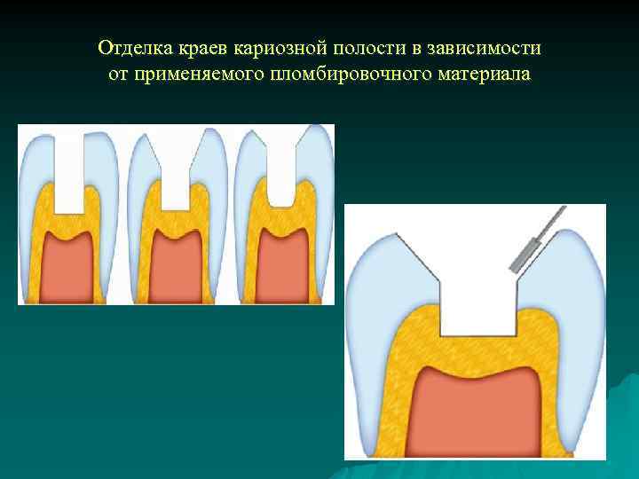 Отделка краев кариозной полости в зависимости от применяемого пломбировочного материала 