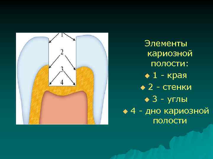 Элементы кариозной полости: u 1 - края u 2 - стенки u 3 -